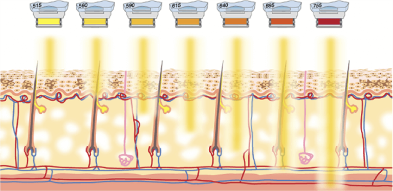 m22 ipl treatment